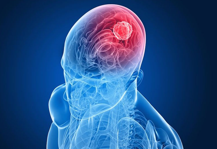 Brain Tumors Specialist in Varanasi Dr. Pawan Kumar Agarwal